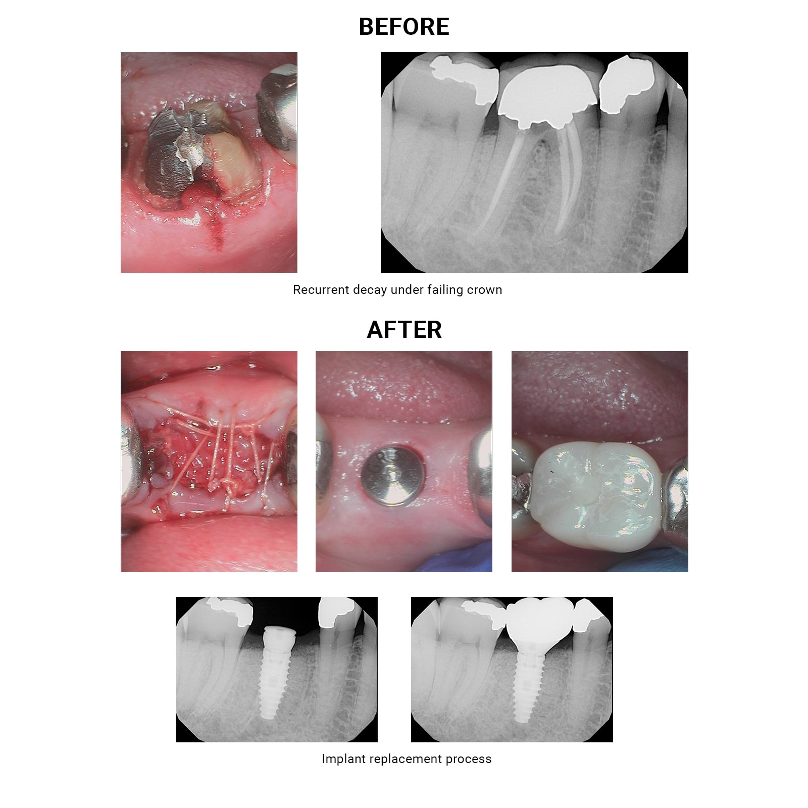 Exo Implant Archives Schwenksville Dental Care Exo Implant Archives Schwenksville Dental Care