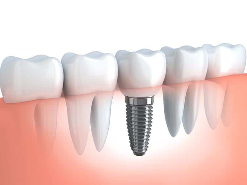 dentalimplants_img