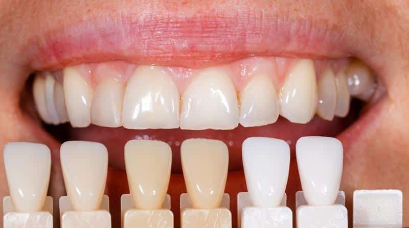 veneers_img